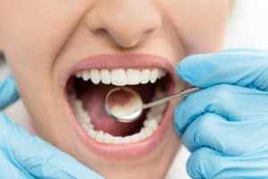 A dentist working to fill a cavity on a patient.