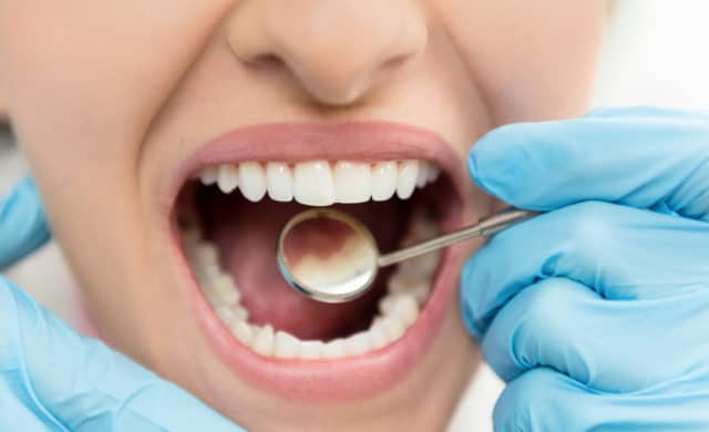 A dentist doing dental work and filling a cavity on a patient.