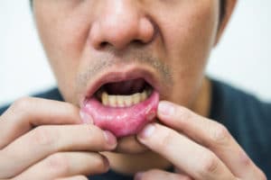 A man showing a canker sore in his mouth