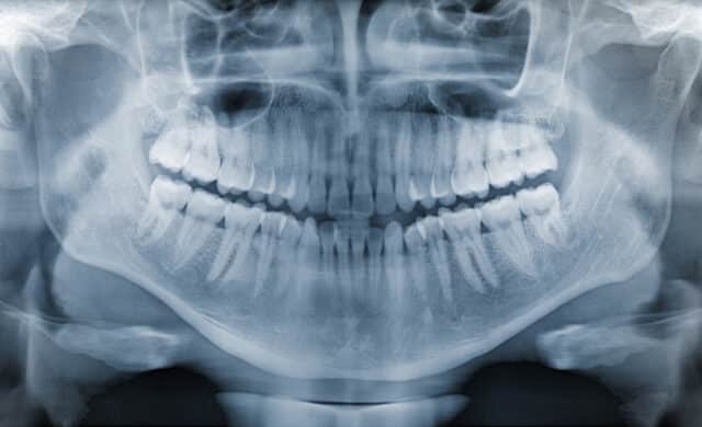 what do dental x-rays show blog post header