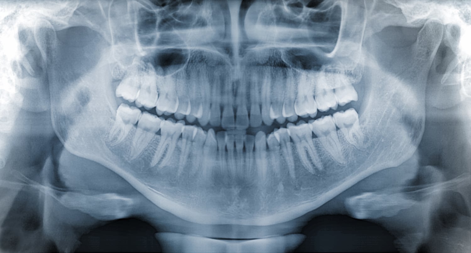 what do dental x-rays show blog post header