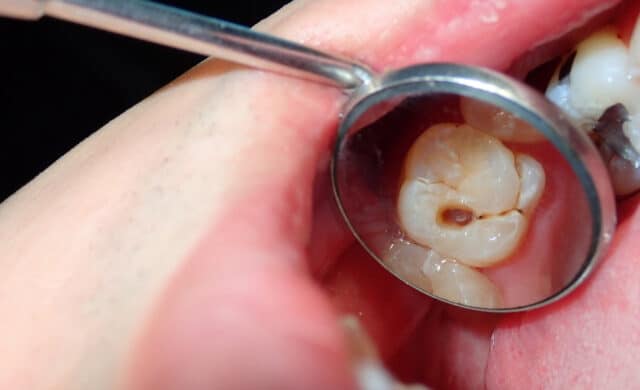 what causes cavities in teeth