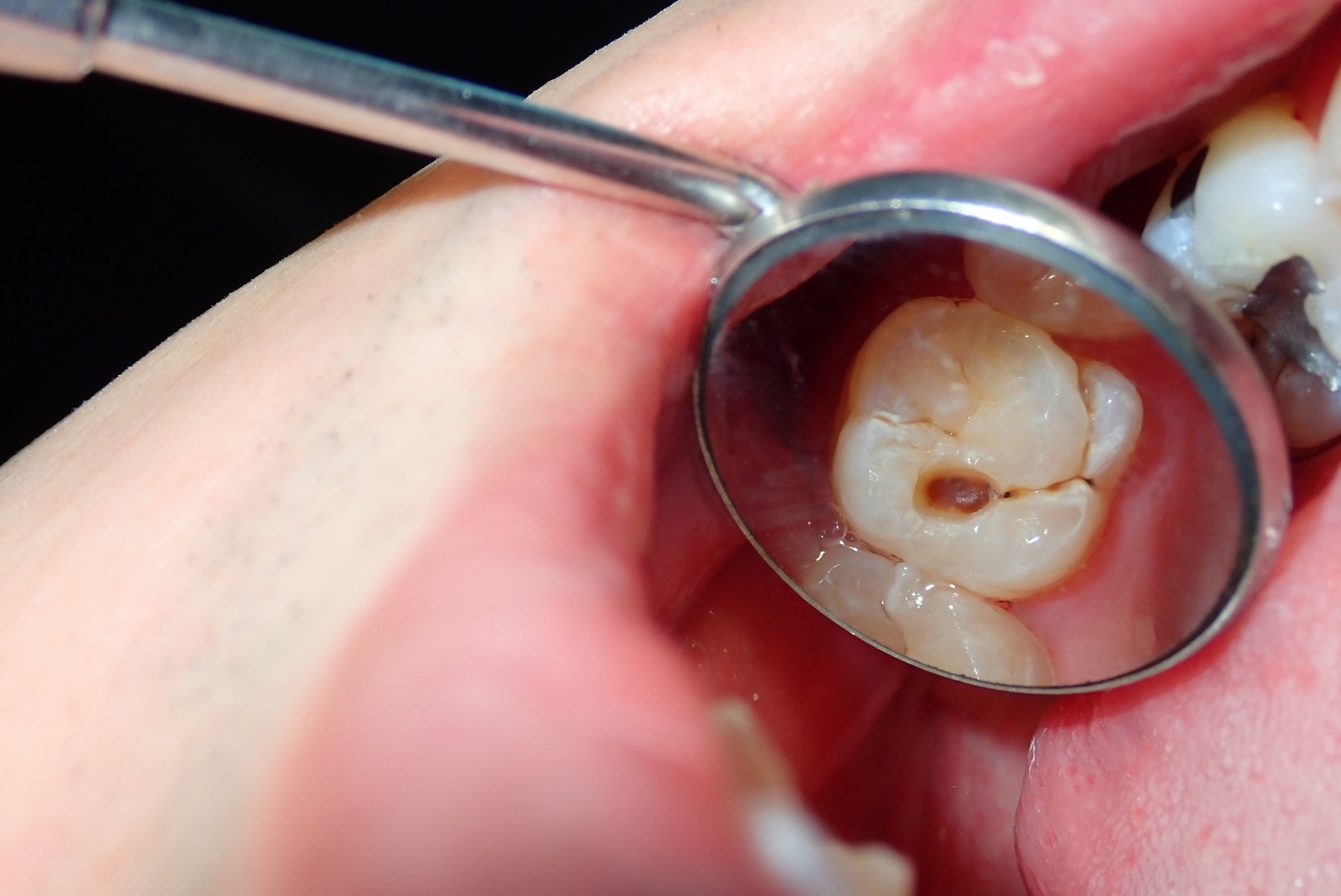 what causes cavities in teeth