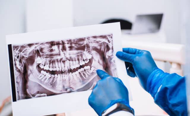 doctor examining x-ray showing wisdom teeeth