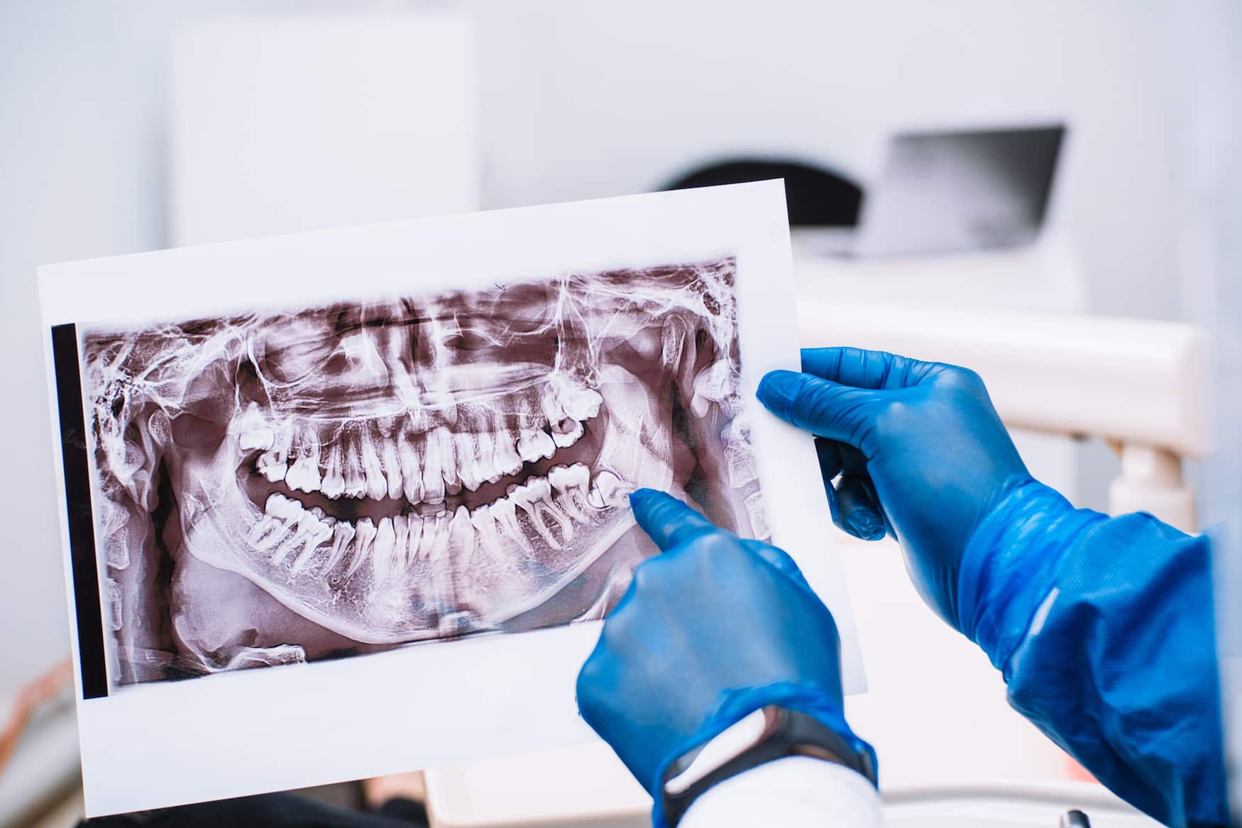 doctor examining x-ray showing wisdom teeeth