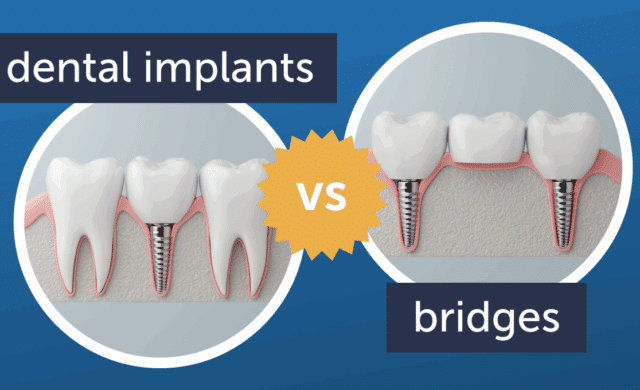 dental implants vs bridges
