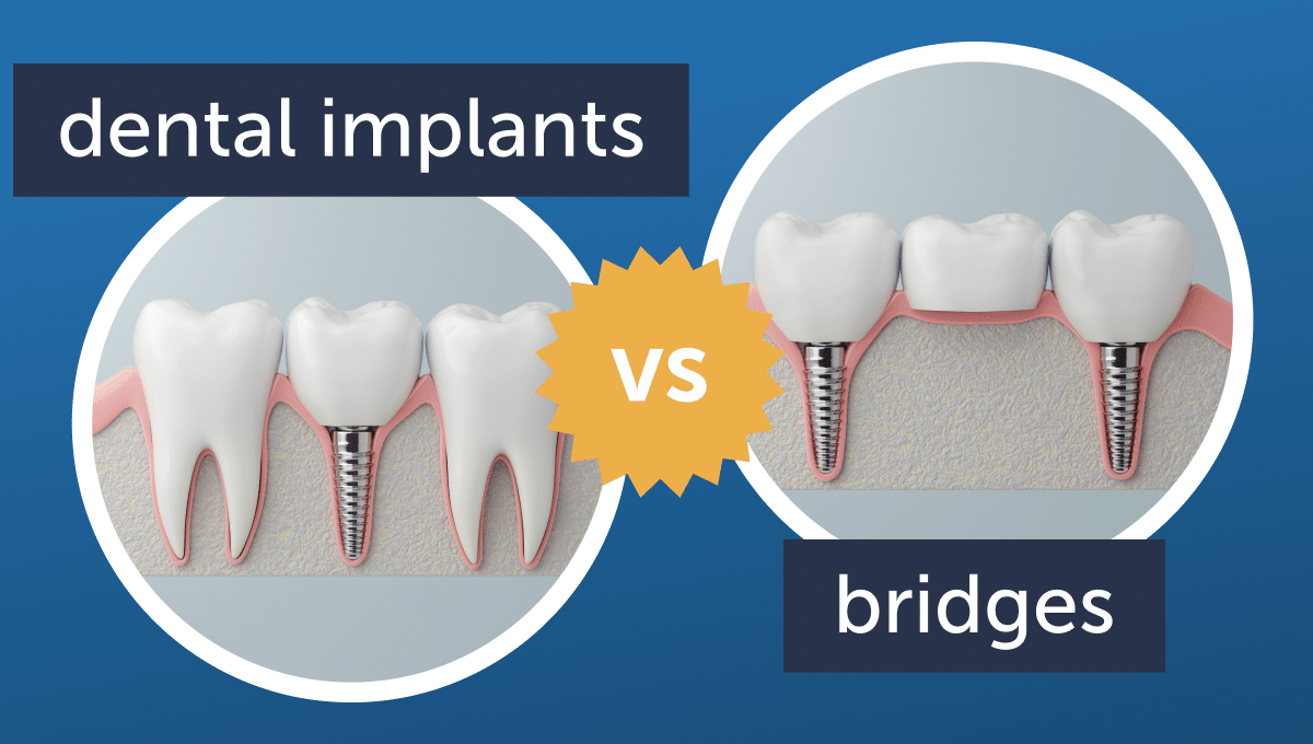 dental implants vs bridges