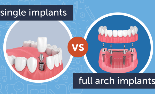 Single Tooth vs Full Arch Implants